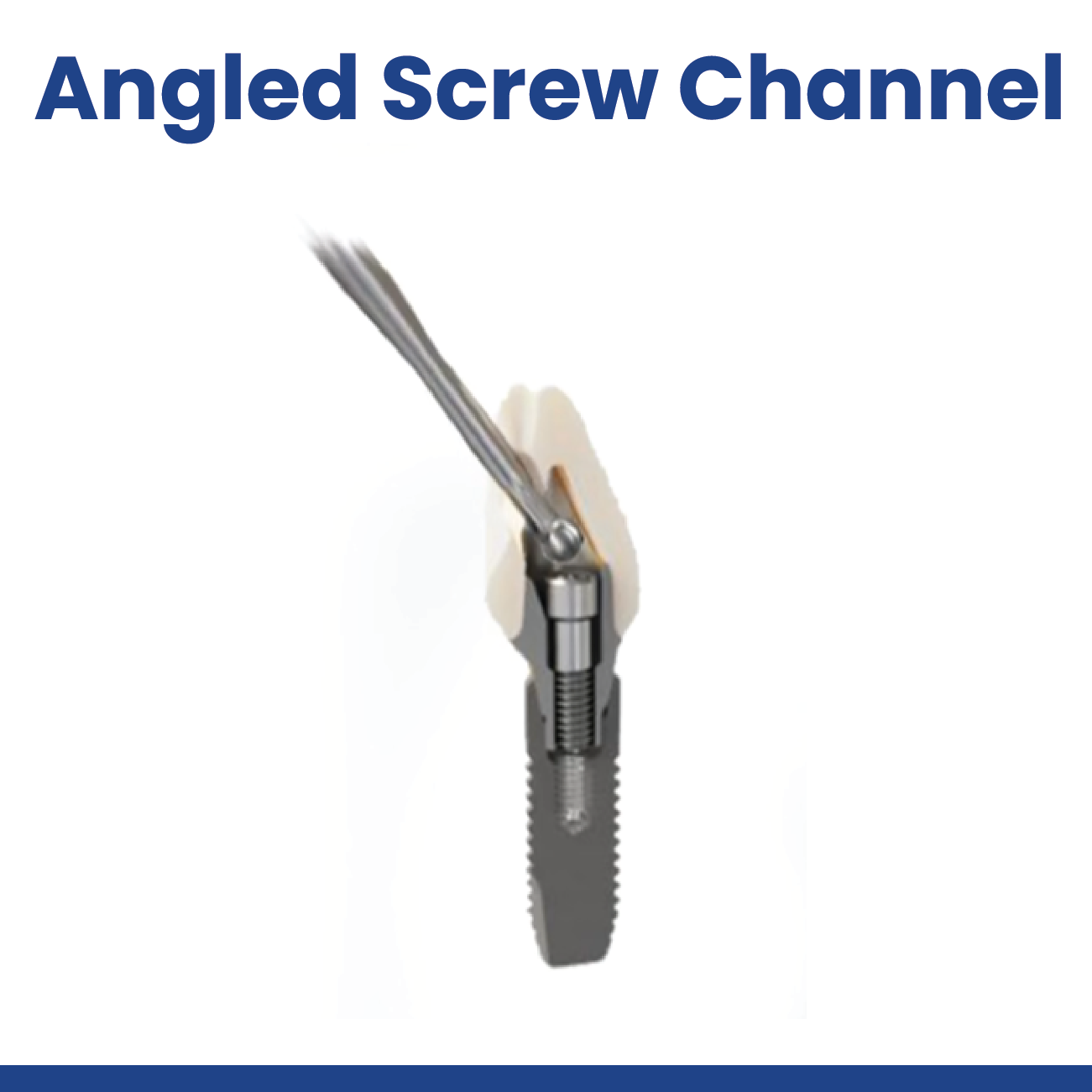 Angled Screw Channel