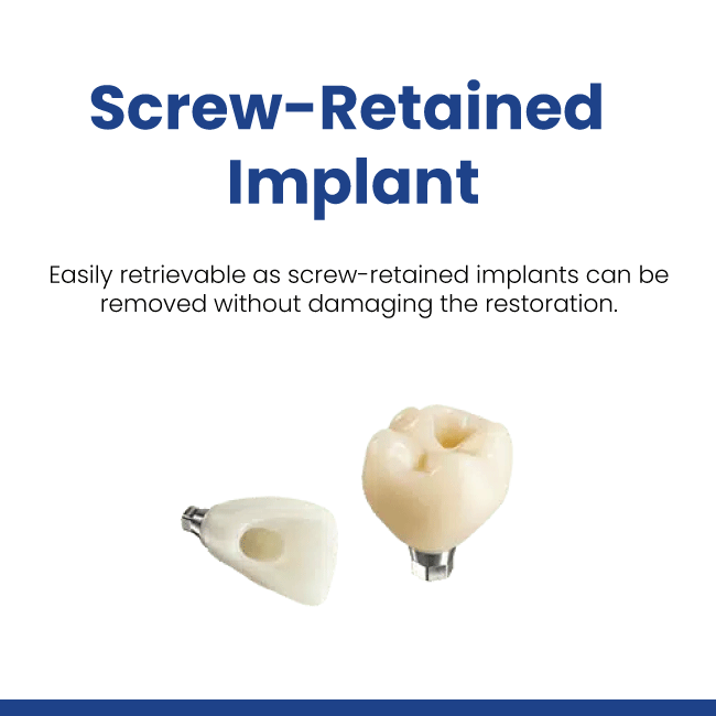 Screw-Retained Implant